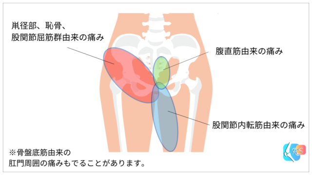 グロインペイン